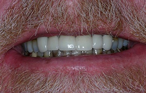 Closeup of teeth following treatment for advanced decay